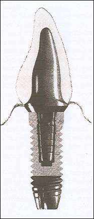 Implantat 
mit Aufbau und Krone